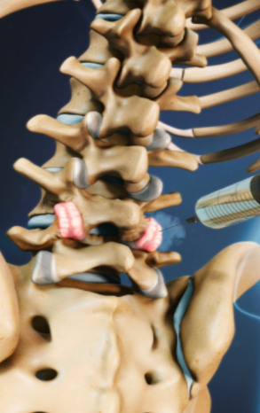 Are you looking for, “will acupuncture help lumbar stenosis?” We discuss the benefits of acupuncture compared to those of conventional therapies for lumbar stenosis.