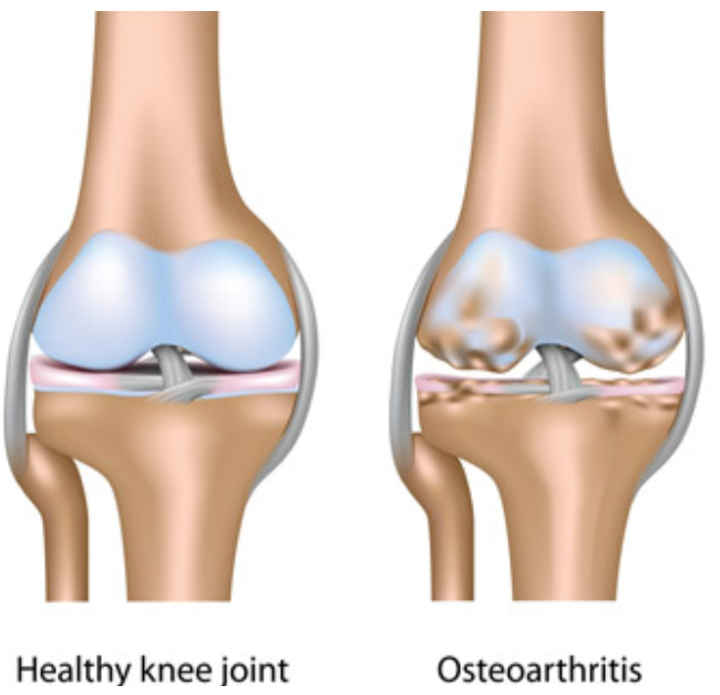 Knee Arthritis - VIP Medical Group