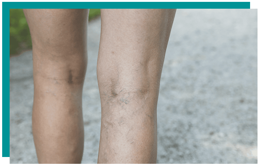 Are you looking for the best vein doctor San Diego? In this article, we introduce you to the two best vein specialists in San Diego and Southern California.