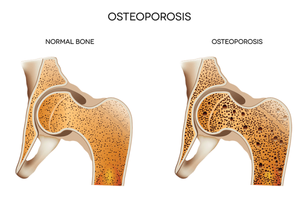 Osteoporosis: Symptoms, Causes and Treatment