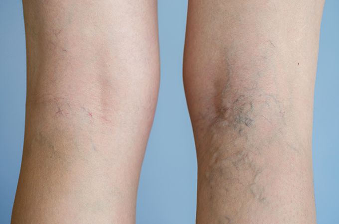 Varicose veins and spider veins are indicative of underlying vein disease. In this article, we discuss “how to find the best varicose and spider vein doctor near me”? Schedule a free consultation today with one of our vein specialists in New York, New Jersey. Call today at (646) 494-4043