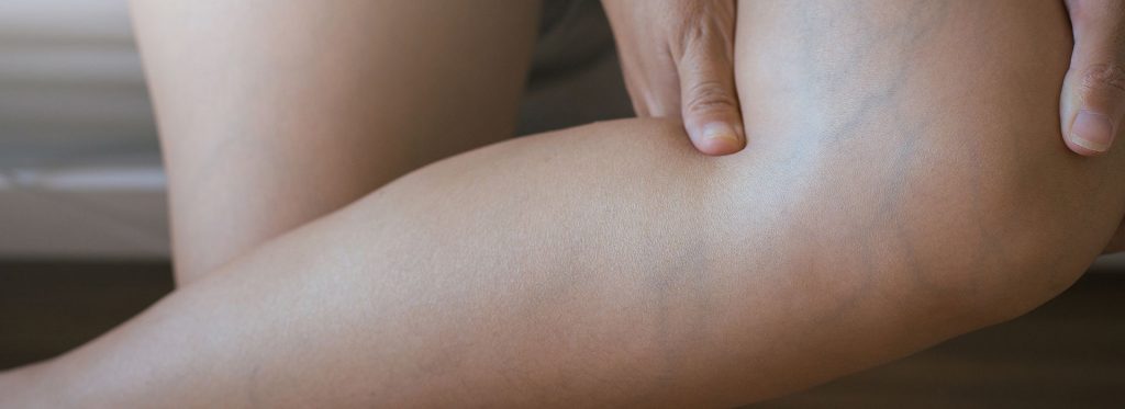 Are you looking for the best new vein treatment in Illinois? In this article, we discuss varicose vein treatments provided by the best vein clinic in Illinois.