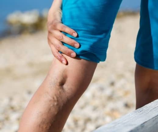 There are a number of complications associated with burst varicose veins, some of which can be fatal. Read on to find out how to treat burst varicose veins. Schedule a free consultation today with one of our burst varicose veins specialists in New York, New Jersey. Call today at (646) 494-4043.