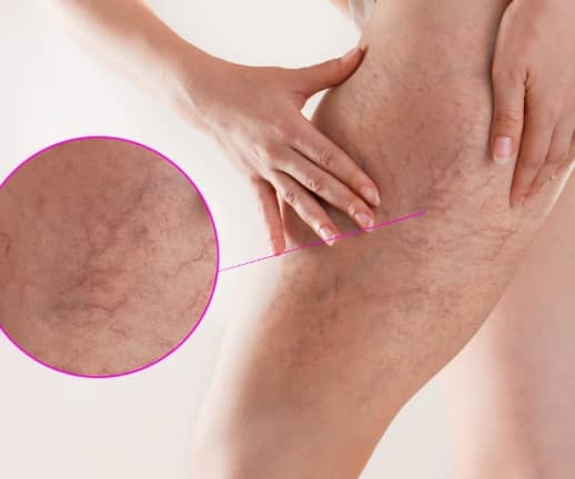 Blue Light Therapy For Spider Veins