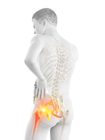 That Hip Pain Could Actually Be a Sciatica Problem - Physical Therapists NYC