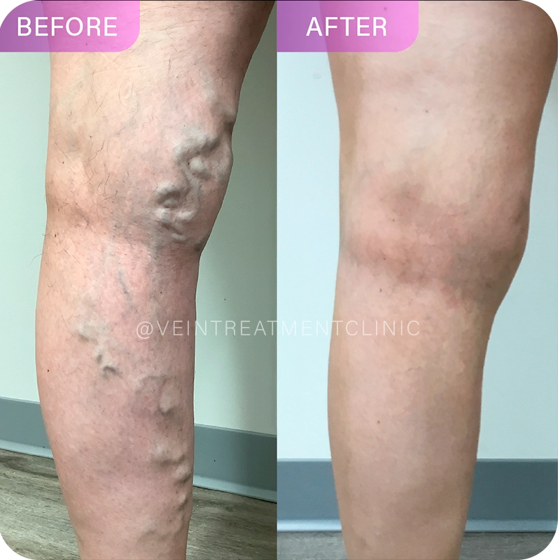 A medical "Before" and "After" comparison of a patient's leg treatment at Vein Treatment Clinic. The left "Before" panel shows a lower leg with large, bulging, and twisted varicose veins. The right "After" panel shows the same leg with a smooth, clear appearance and no visible signs of the varicose veins, demonstrating the effectiveness of the clinic's specialized vein treatments.