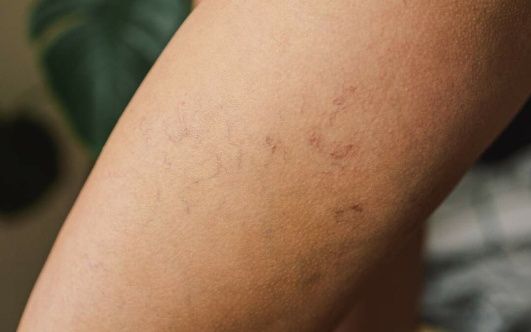What Are Spider Veins and Why Should They Be Treated?