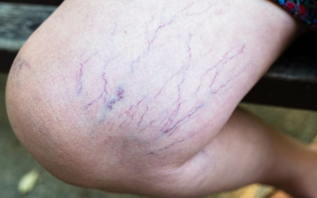 What Causes Spider Veins? Learn the Common Reasons!