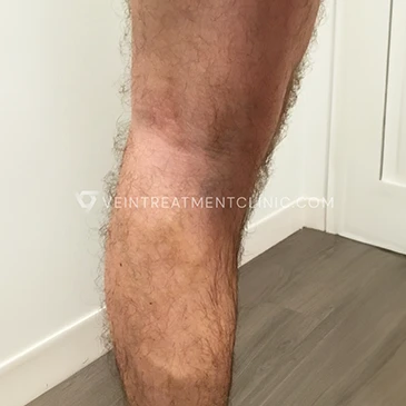 After Treatment