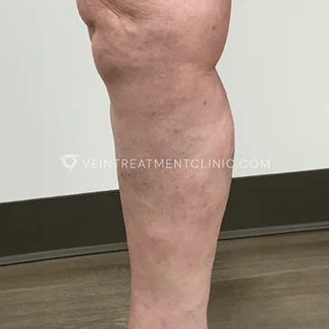 After Treatment