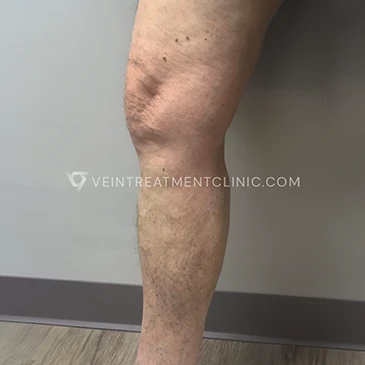 After Treatment