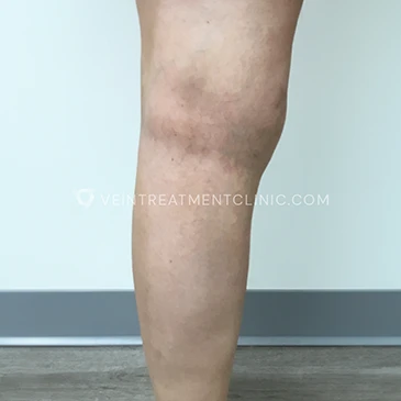 After Treatment