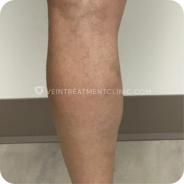 After Treatment