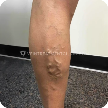 Before Treatment