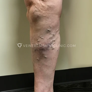 Before Treatment