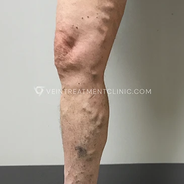 Before Treatment