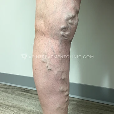 Before Treatment