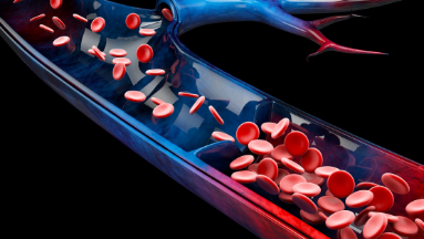 Chronic venous insufficiency photo