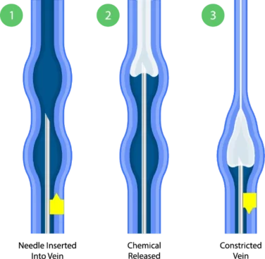 Medical illustration of sclerotherapy, showing a solution injected into a varicose or spider vein to close and treat the vein.