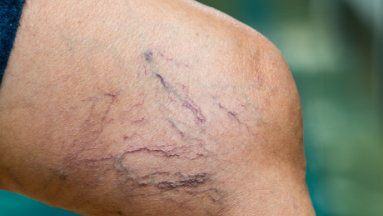 Spider veins photo