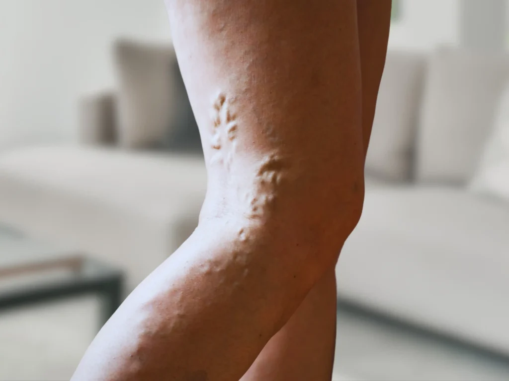 Treat Your Vein Diseases in Farmington, CT