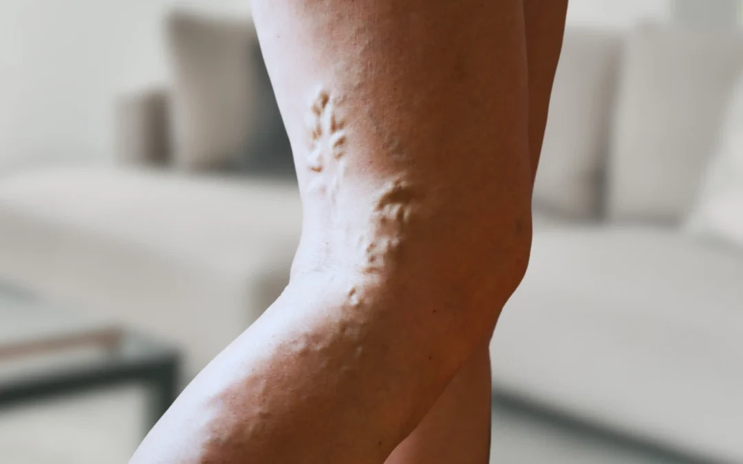 Treat Your Vein Diseases in Farmington, CT