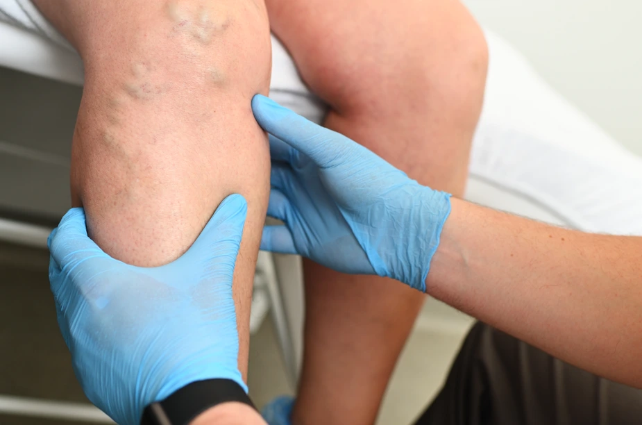 Treat Your Vein Disease in Hamden, CT, With Dr. Martin Tyson