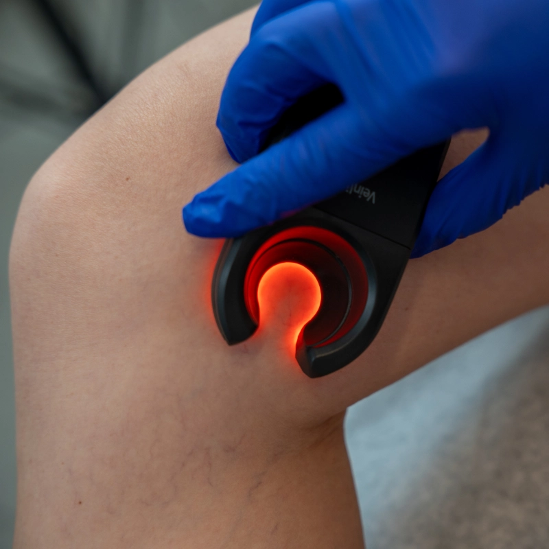 A close-up of a healthcare professional's hand in a blue medical glove using a Veinlite device on a patient's leg. The device emits a bright orange-red circular light to illuminate and identify underlying spider veins for treatment.