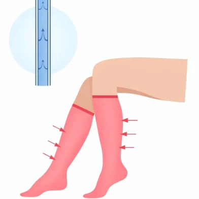 Illustration showing the effects of compression therapy to treat vein diseases after procedures.