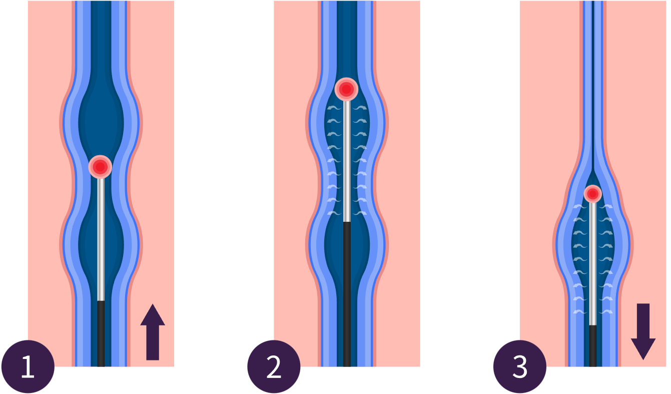Medical illustration of endovenous laser treatment (EVLT), showing a laser fiber used to heat and close a varicose vein from the inside.