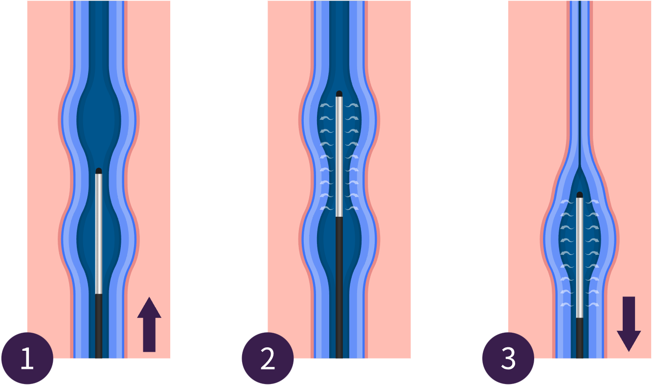 Medical illustration of radiofrequency ablation (RFA), showing a catheter delivering heat to close a diseased vein and restore healthy blood flow.