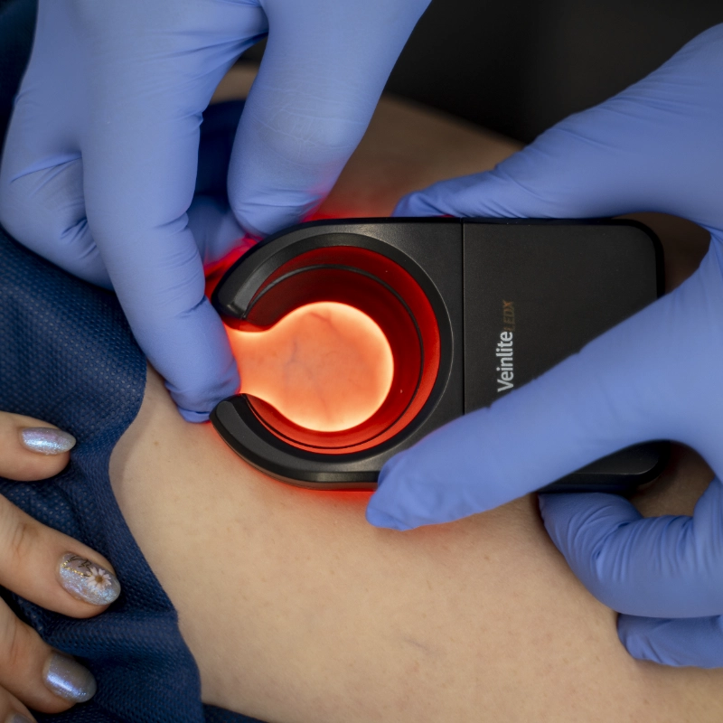 A close-up procedural image showing a healthcare provider wearing blue gloves using a red light-emitting handheld device on a patient's leg. The device appears to be a diagnostic tool, possibly a Veinlite for assessing venous conditions such as Varicose Veins or Spider Veins. The patient's leg is exposed and the procedure is being performed on the skin surface.