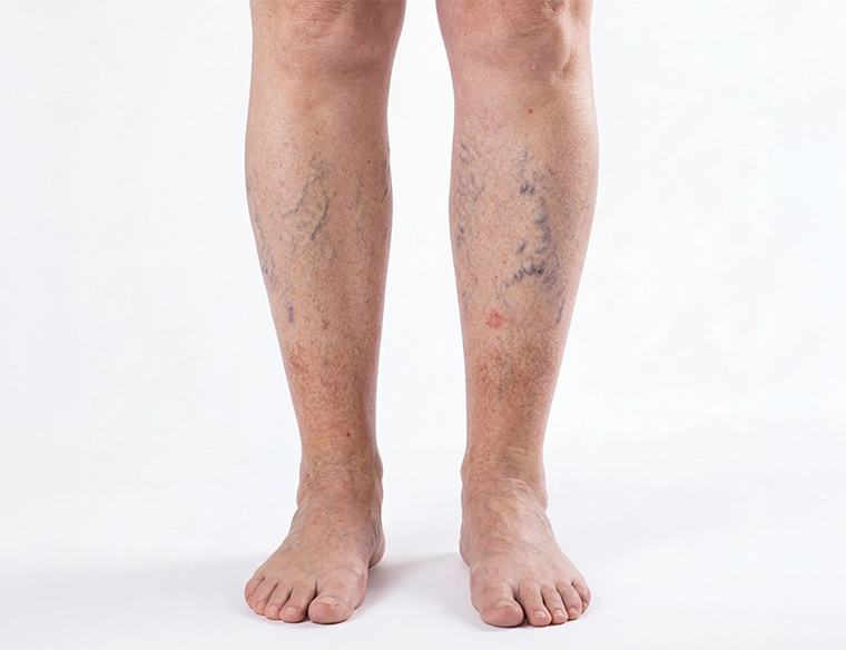 A close-up view of the back of a person's legs, from the thighs to the knees, showing a visible network of red and purple spider veins on the surface of the skin. The image is set against a solid light pink background.