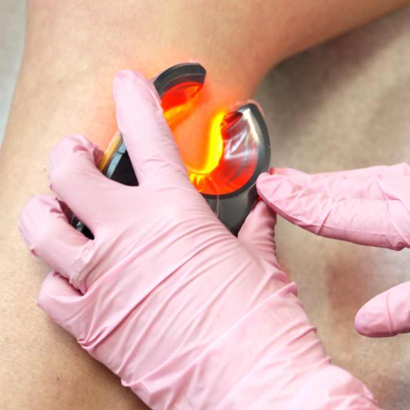 A close-up of a healthcare professional's hand in a blue medical glove using a Veinlite device on a patient's leg. The device emits a bright orange-red circular light to illuminate and identify underlying spider veins for treatment.