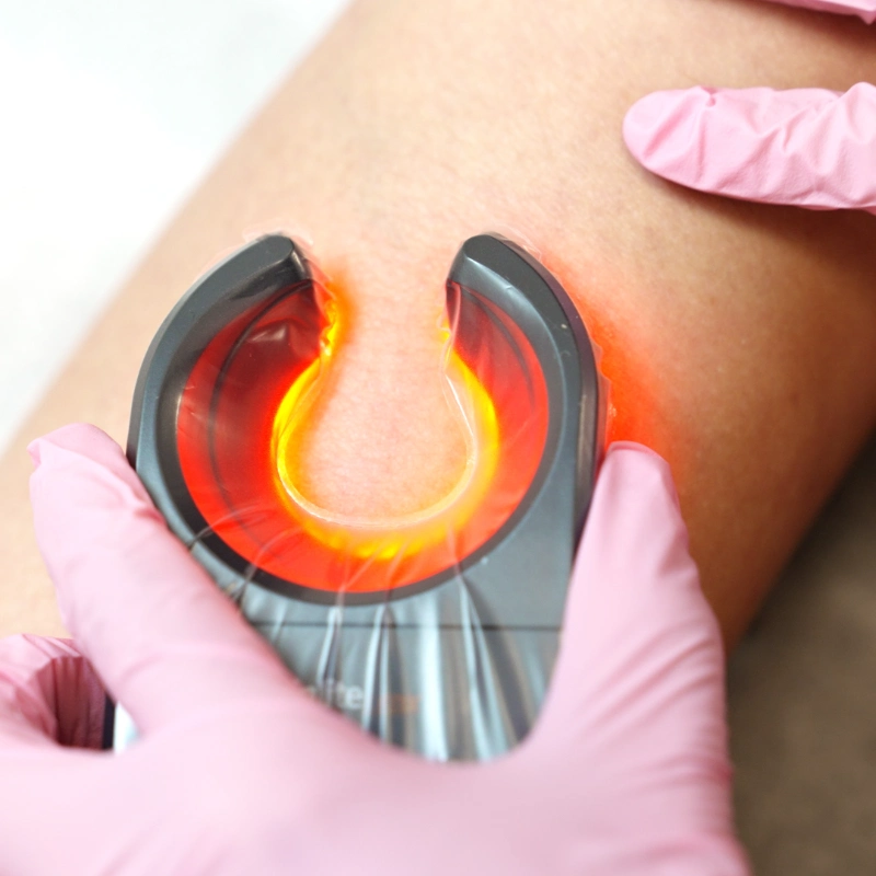 A close-up of a healthcare professional's hand in a blue medical glove using a Veinlite device on a patient's leg. The device emits a bright orange-red circular light to illuminate and identify underlying spider veins for treatment.
