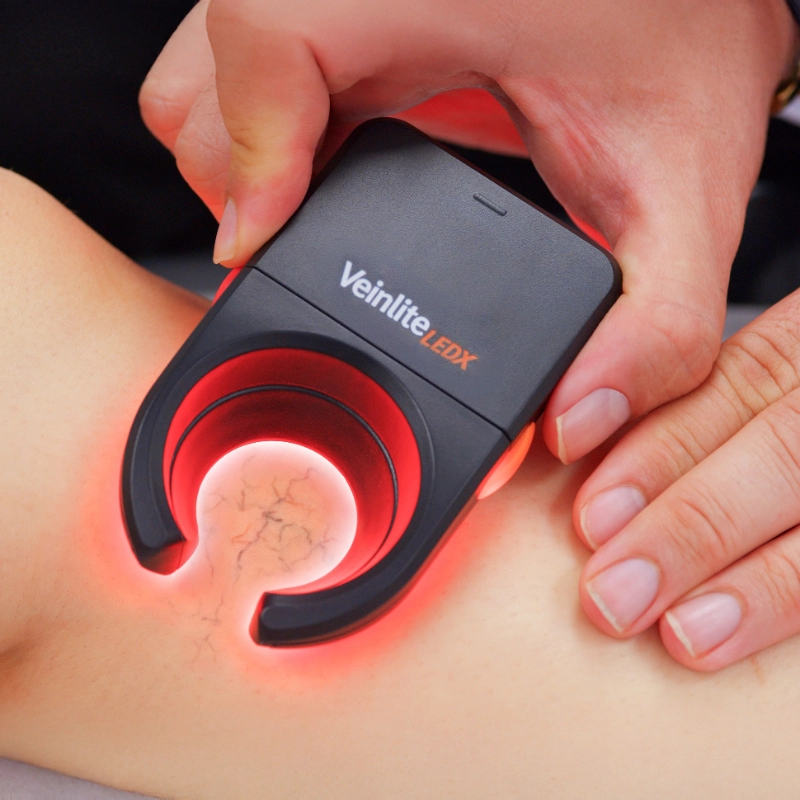 A close-up of a healthcare professional's hand in a blue medical glove using a Veinlite device on a patient's leg. The device emits a bright orange-red circular light to illuminate and identify underlying spider veins for treatment.