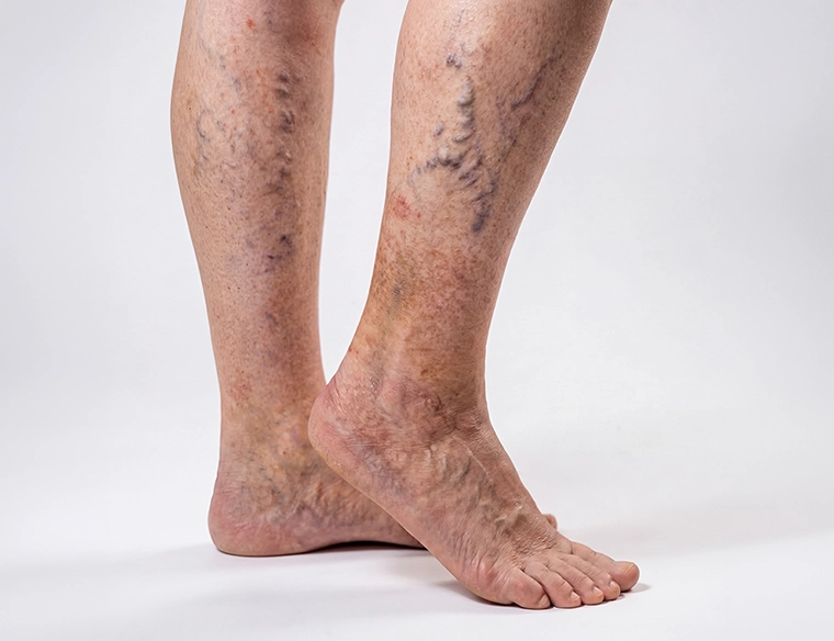 A close-up view of a person's bare legs, showing visible veins spider veins, varicose veins and some redness on the right calf against a solid white background.
