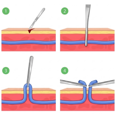 Medical illustration of ambulatory phlebectomy, showing how a varicose vein is removed through small skin incisions.