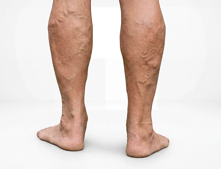 A back view of a person's lower legs standing barefoot on green grass, showing prominent, bulging varicose veins on the calves and behind the knees. The person is wearing tan cargo shorts. The image is set against a solid light pink background.