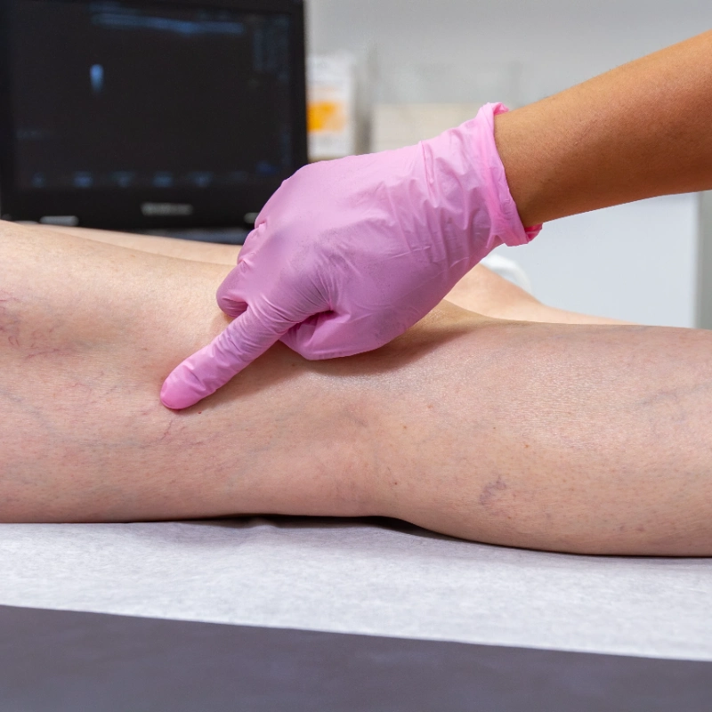 A healthcare provider wearing pink medical gloves is performing a clinical examination of a patient's leg and calf area, which displays visible Varicose Veins. The patient's leg is being palpated during what appears to be a venous assessment in preparation for potential vein treatment evaluation. Duplex Ultrasound equipment is visible in the background of the medical office setting.