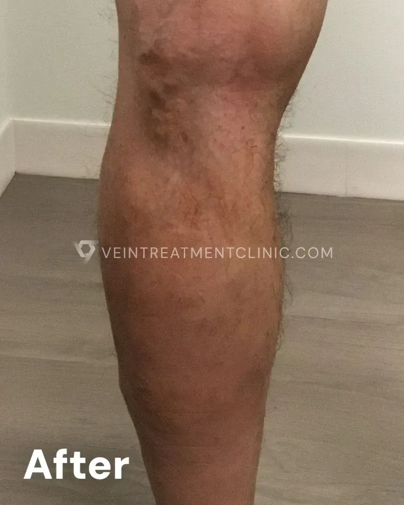 Varicose Veins — Calves & Knees after