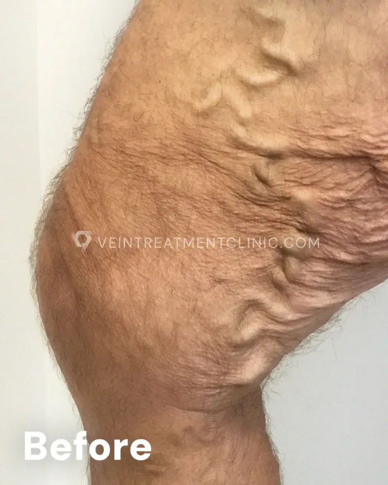 Varicose Veins — Knees & Thighs before