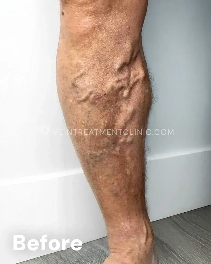 Varicose Veins — Calves & Thighs before